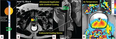 Evolving imaging methods of prostate cancer and the emergence of magnetic resonance imaging guided ablation techniques